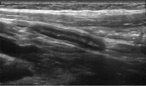 Appendix Normal Ultrasound - ALiEM