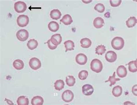 Hypochromia | Medical Laboratories