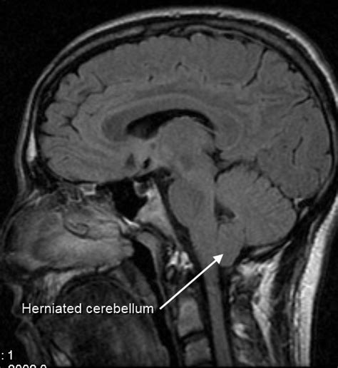 File:MRI of human brain with type-1 Arnold-Chiari malformation and ...