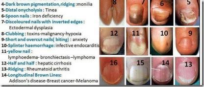 Are your fingernails healthy, or sending you a health warning ...