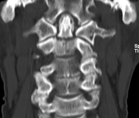 C2 Odontoid Fracture