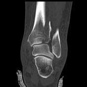 Pilon fracture - Radiopaedia.org | Radiology imaging, Fractures, Radiology