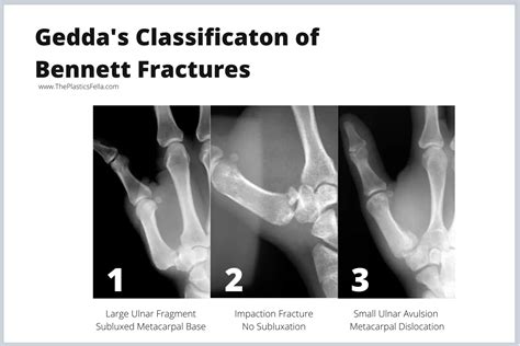 Bennett Fracture - X-Rays, Diagnosis, Treatment.