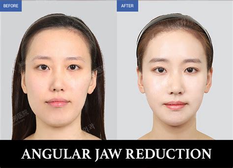 Angular Jaw Reduction -ENG | Gangnam Group Plastic Surgery