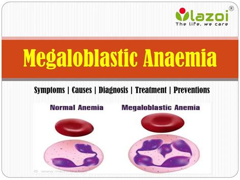 PPT - Megaloblastic Anaemia: Symptoms, causes, diagnosis, treatment and preventions. PowerPoint ...