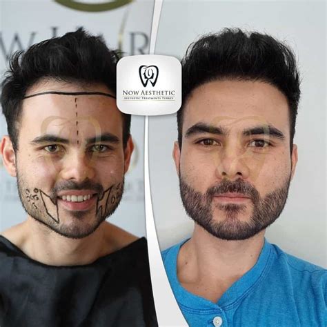 Beard Transplant Before and After 2023 - Now Aesthetic