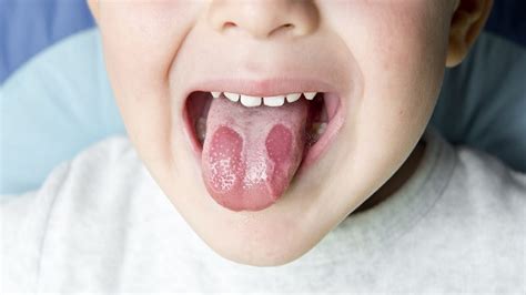 Natural Treatments For Burning Tongue Syndrome