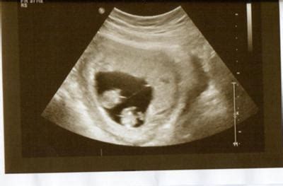 Twins 11 Weeks Ultrasound, Fraternal or Identical?