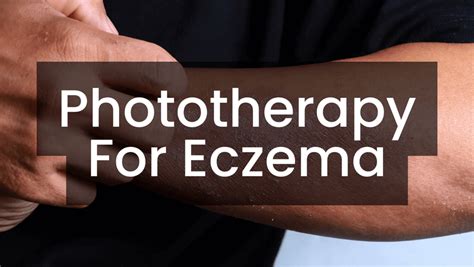 Phototherapy for Eczema – Care Lamps