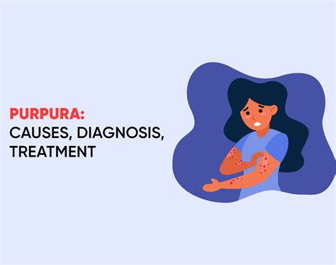 All You Need to Know About Purpura: Causes, Diagnosis,Treatment