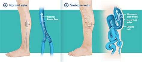 Varicose Veins Sydney | Restless Legs Syndrome Treatment Sydney