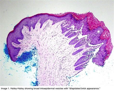 Pathology Outlines - Hailey-Hailey disease
