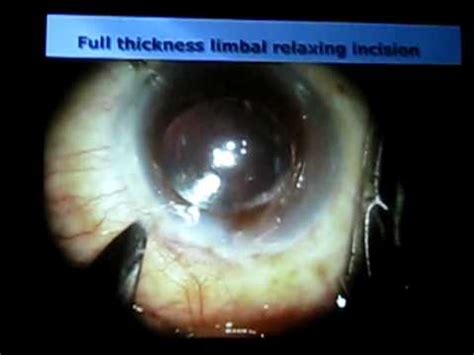 Corneal Limbus