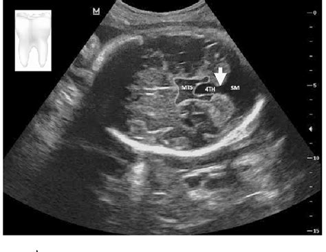 Diagnosis of Joubert syndrome via ultrasonography | Semantic Scholar