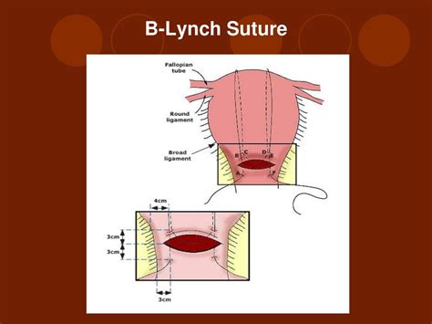 PPT - Post Partum Hemorrhage PowerPoint Presentation, free download - ID:6866100