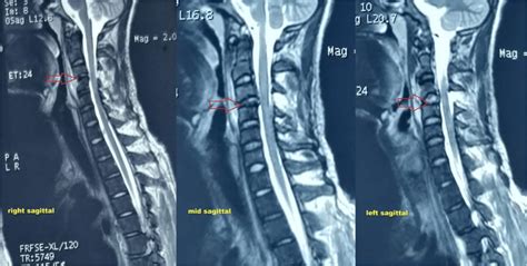 MRI of cervical spine revealing C3–C4 intervertebral disc injury and ...