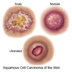 Squamous Cell Carcinoma - What You Need to Know