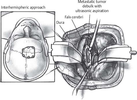 Superior Parietal Lobule Approach | Neupsy Key