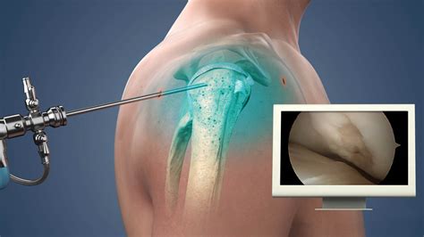 Shoulder Arthroscopy – Dr. Munde's Speciality Center