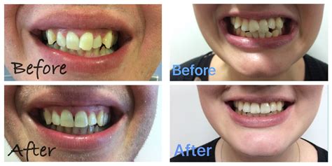 Invisible Braces | Teeth Straightening | Churchfield Dental Centre