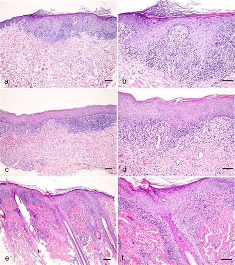 Erosive Lichen Planus Histology