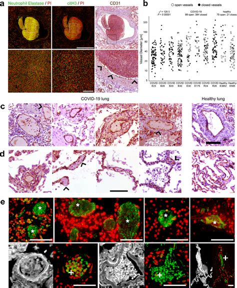 Neutrophil Extracellular Traps Nets