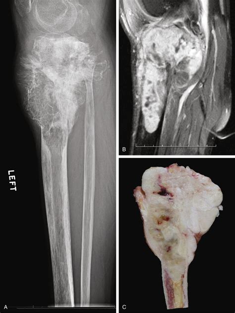 Osteosarcoma | Basicmedical Key