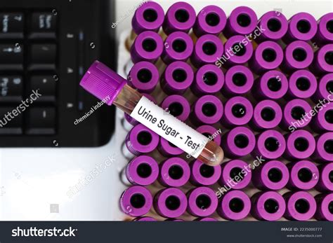 Urine Sugar Test Look Abnormalities Urine Stock Photo 2235000777 | Shutterstock