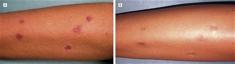 Mycobacterium bolletii/Mycobacterium massiliense Furunculosis Associated With Pedicure ...