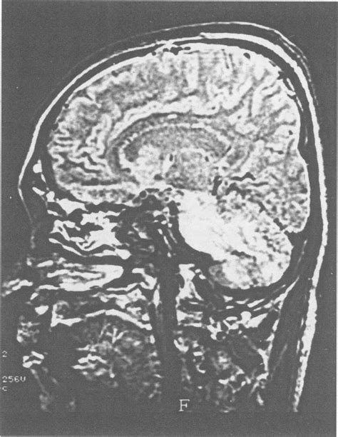 MRlfindings of the brain. Tl-weighted MRI image (parasagittal plane).... | Download Scientific ...