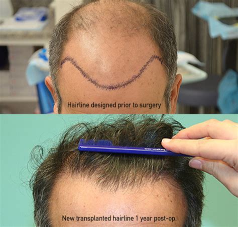 Best Hair Transplant in California, (CA) - Sara Wasserbauer, MD