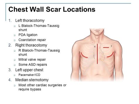 Pacemaker Icd Scar / Archives Of Plastic Surgery : Icd's are implanted in patients with ...