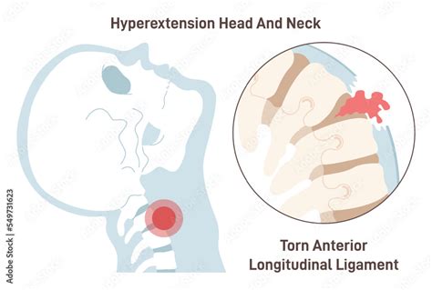 Vecteur Stock Neck hyperextension. Anterior longitudinal ligament torn. Spinal cord | Adobe Stock