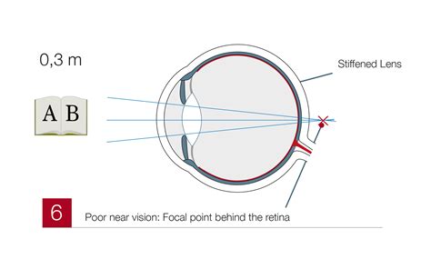 Presbyopia - Correction & Treatment at Test Winner EuroEyes