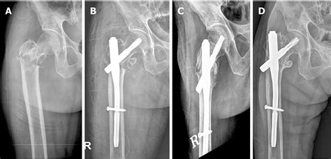 Does Proximal Femoral Nail Antirotation Achieve Better, 47% OFF