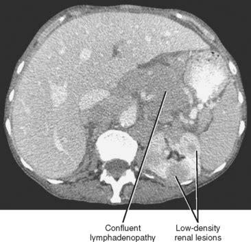 Porta Hepatis Lymph Node