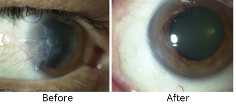 Pterygium