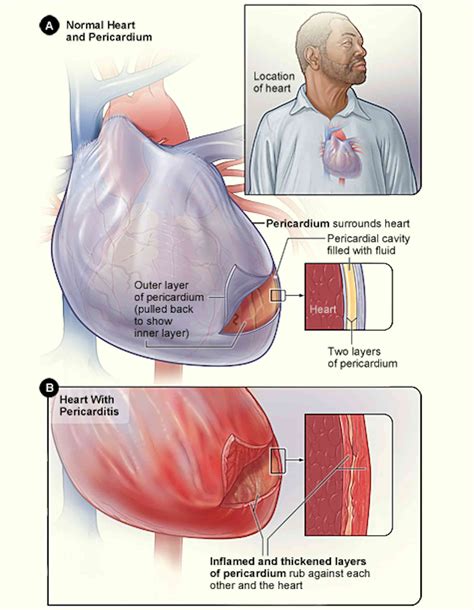 COVID-19 can harm your heart and what student athletes need to know