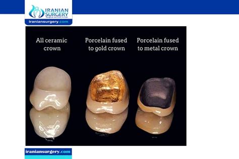 Common Materials Used for Making Dental Crowns | Iranian Surgery