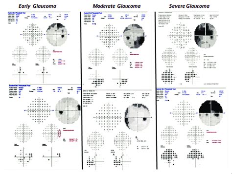 Glaucoma Defects