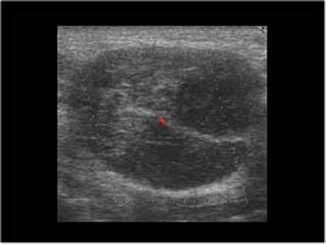 Head and Neck | 4.3 Salivary glands : Case 4.3.4 Warthin's tumors ...