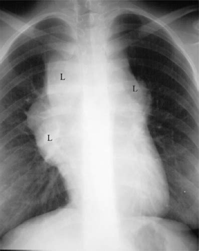 Radiology of Mediastinal Masses | Thoracic Key