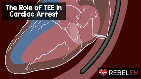 The Role of TEE in Cardiac Arrest - REBEL EM - Emergency Medicine Blog