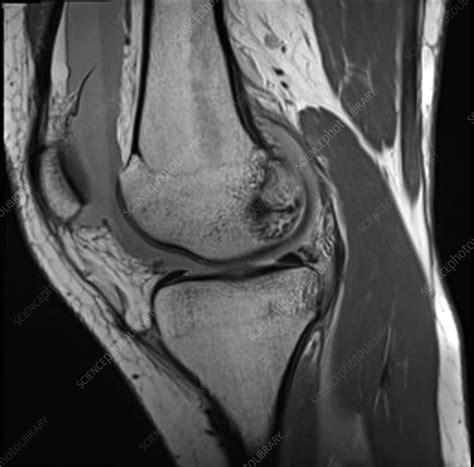 Hemarthrosis, MRI - Stock Image - C039/3340 - Science Photo Library