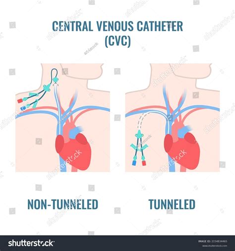 70 Tunneled Catheter Images, Stock Photos & Vectors | Shutterstock