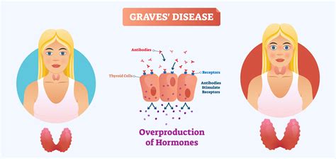 Graves’ Disease: Symptoms, Diagnosis and Treatment - Healthsoul