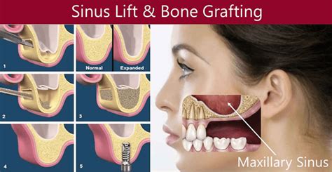 Direct & Indirect Sinus Lift Surgery for Tooth implants Cost