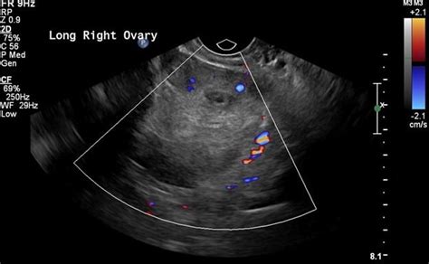 Ovarian Torsion | UAMS Department of Radiology