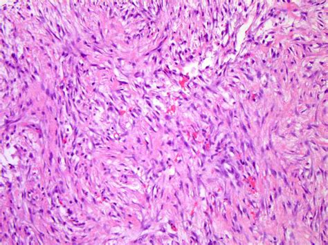 Pathology Outlines - Nodular fasciitis