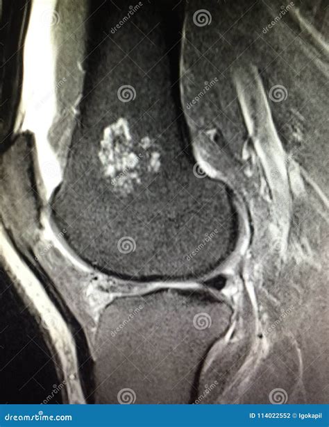 Knee Pathology Chondroid Lesion Enchondroma Mri Stock Photo - Image of ...